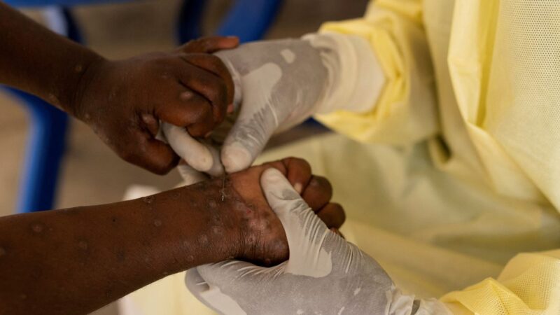 África declara emergência em saúde pública por epidemia de mpox